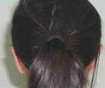 Otoplasty Before & After Otoplasty Before & After