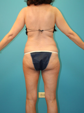 Liposuction Before & After