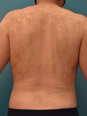 Lipo waist Before & After