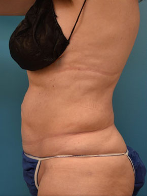 Liposuction abdomen and waist Before & After