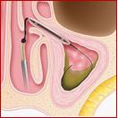 step-2-balloon-sinus-dilation